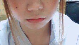 まだ腫れてるぅー