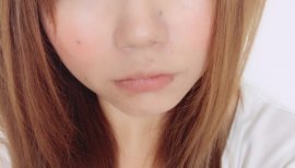 親知らず抜いてくる。。