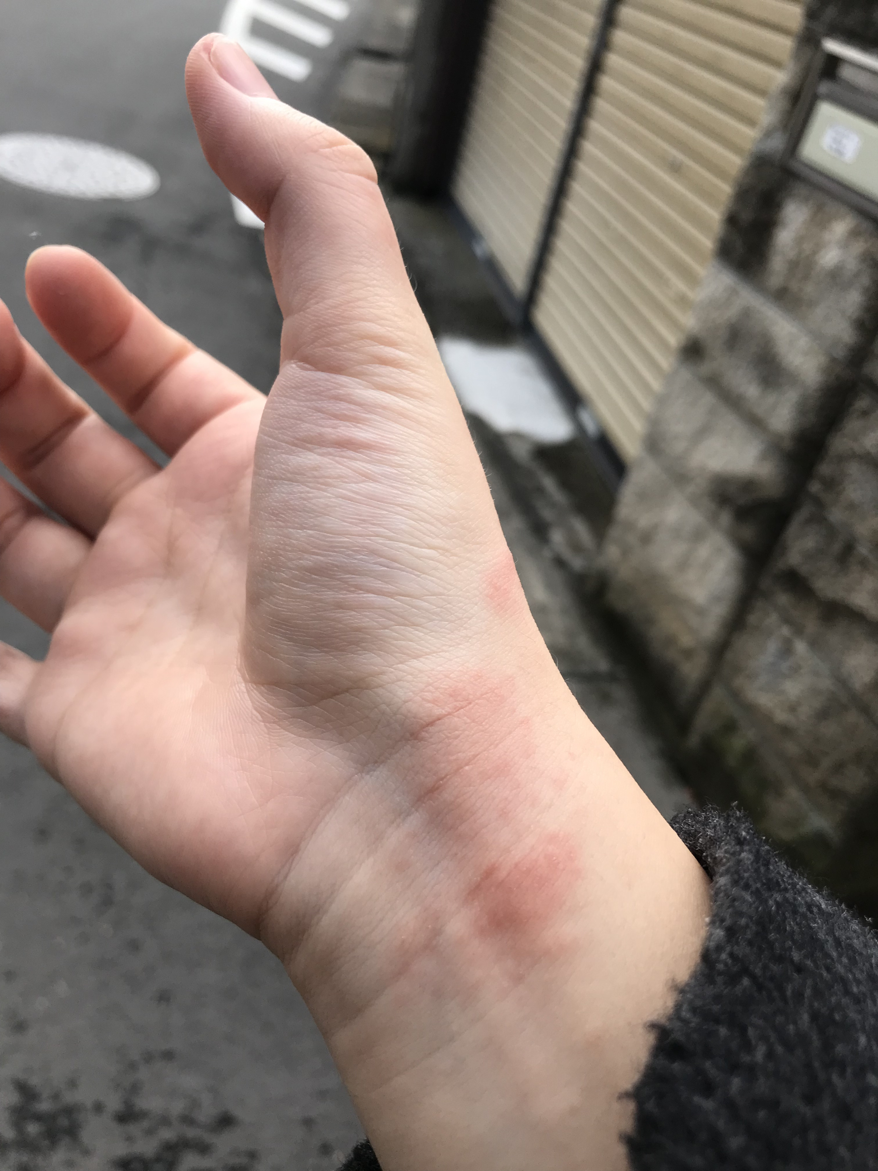 某ピザ屋による手荒れ…