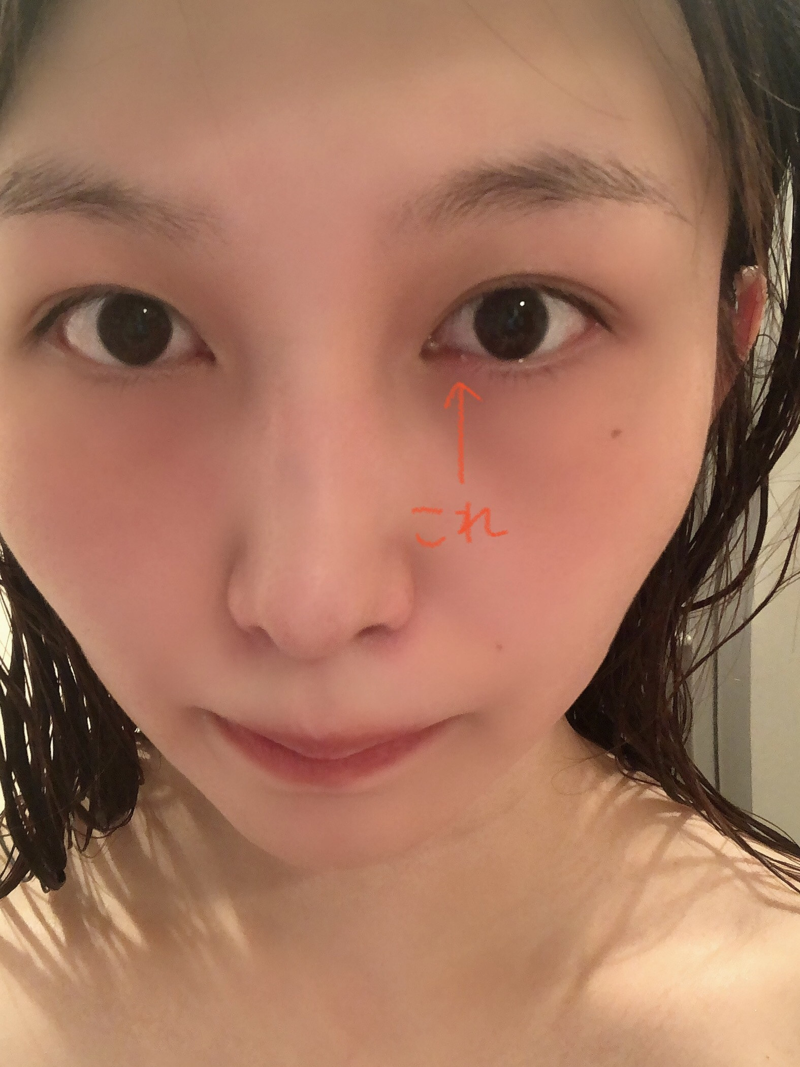 ものもらい？