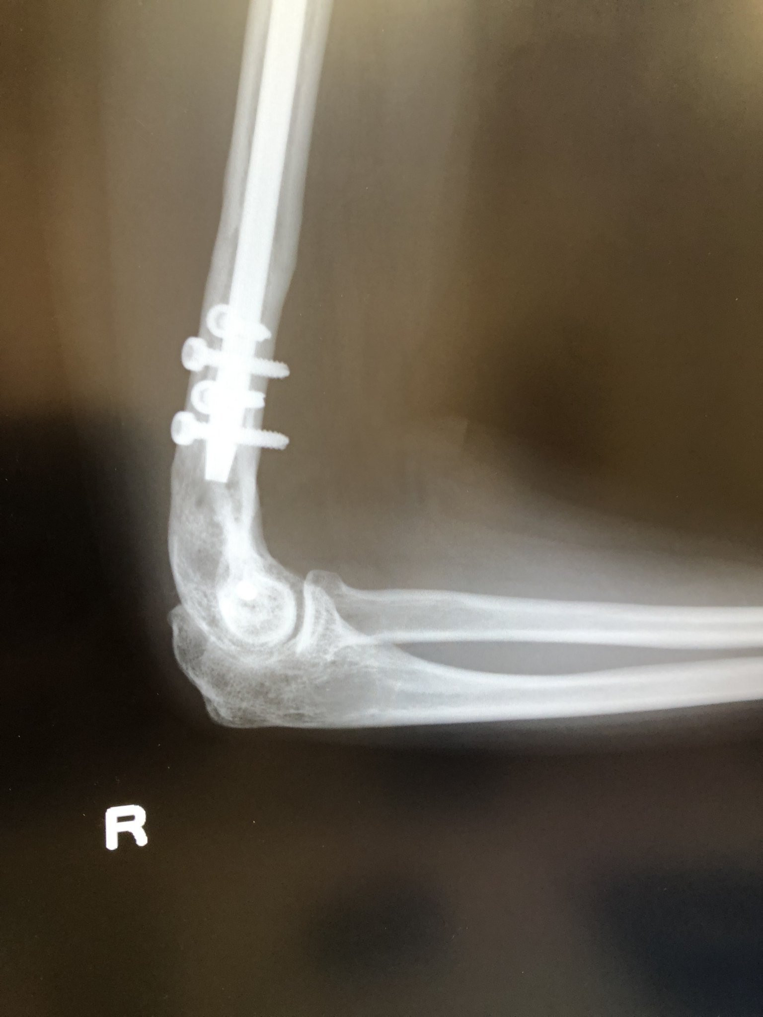 右腕が機械人間！