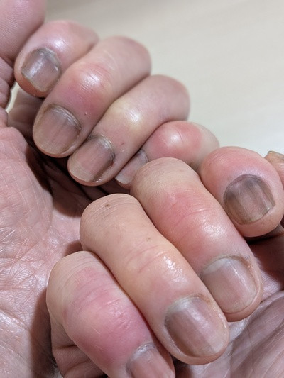 リウマチの悪化（＞＜。。