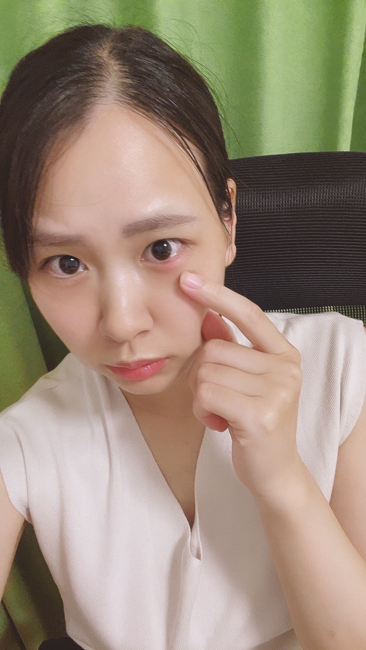 ものもらい再び